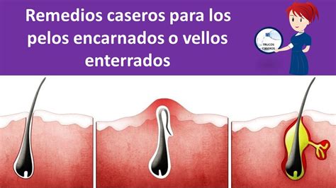 pelos encarnados en la ingle|Vellos encarnados: qué son y cómo eliminarlos